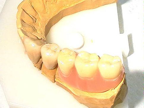 Zahnersatz